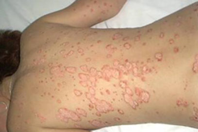 Psoriasis: no dejarse vencer