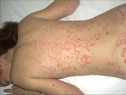 La psoriasis no es contagiosa, pero afecta al 2 % de los cubanos. Fotos: Cortesía del Centro de Histoterapia Placentaria
