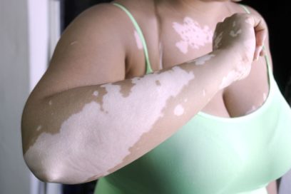 Manchas blancas en la piel: ¿vitíligo?