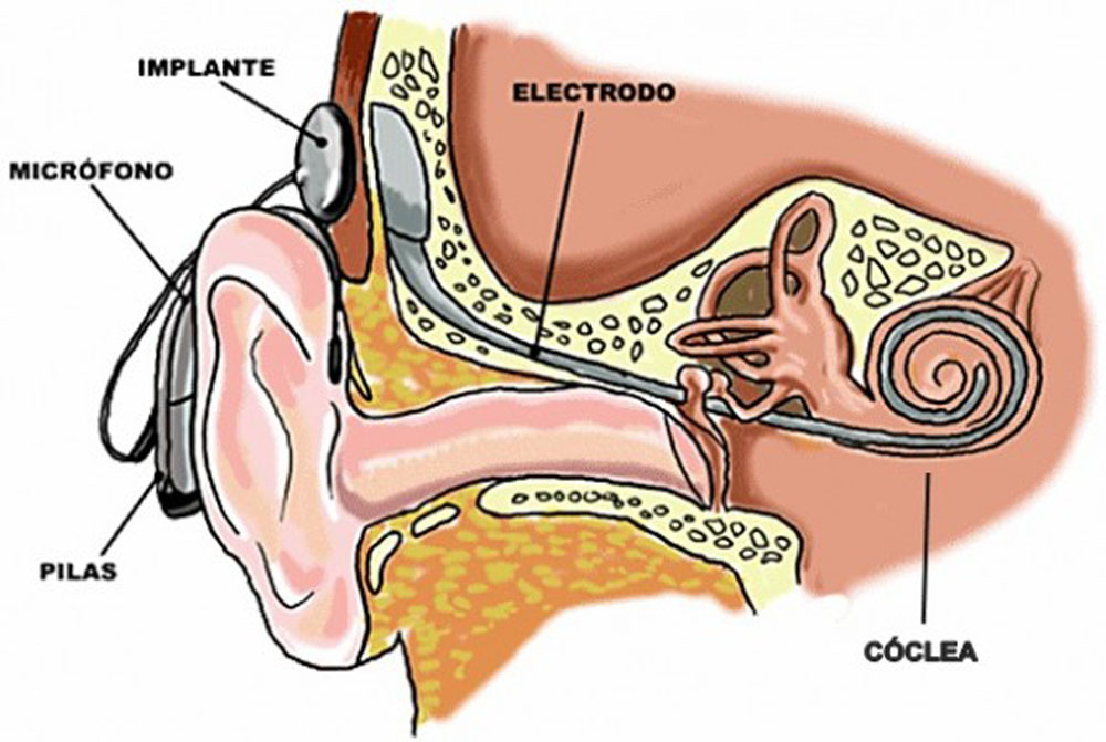 Implante coclear