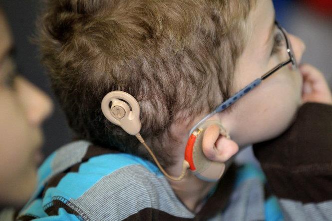 implante coclear Trabajadores.cu