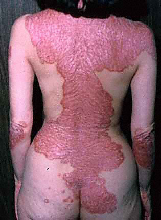 Valen los esfuerzos para poder fabricar el medicamento que alivia la psoriasis.