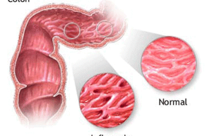 Ganarle terreno al Crohn
