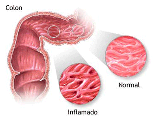 La enfermedad de Crohn puede afectar cualquier porción del aparato digestivo.