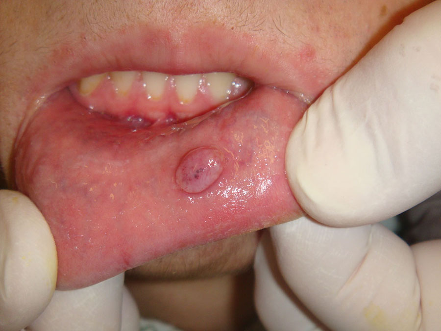 Cualquier lesión en la boca o los labios puede ser un indicio para consultar al estomatólogo; aunque lo más aconsejable es hacerlo istemáticamente.