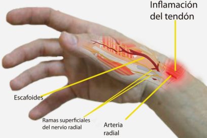 Tendinitis: una enfermedad profesional