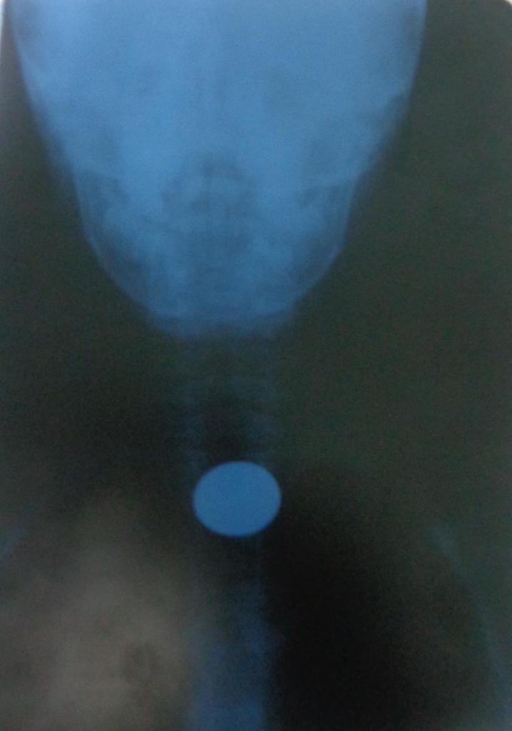 Monedas, aretes, presillas, botones… infinidad de objetos pueden llegar al interior de niñas y niños y desencadenar procesos graves, incluso la muerte. Fotos: Betty Beató