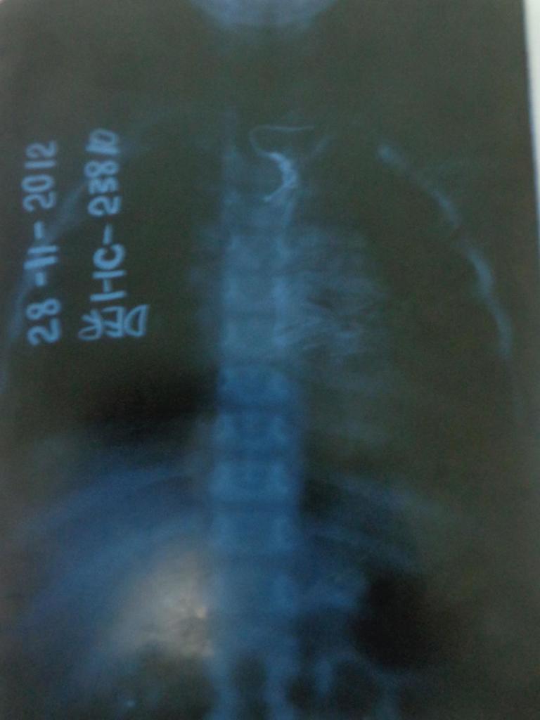 Monedas, aretes, presillas, botones… infinidad de objetos pueden llegar al interior de niñas y niños y desencadenar procesos graves, incluso la muerte. Fotos: Betty Beató