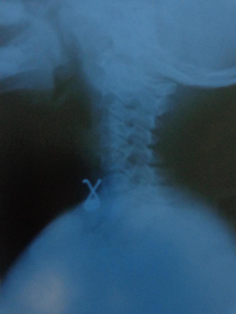 Monedas, aretes, presillas, botones… infinidad de objetos pueden llegar al interior de niñas y niños y desencadenar procesos graves, incluso la muerte. Fotos: Betty Beatón