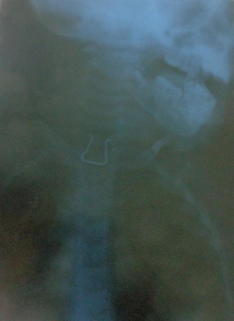 Monedas, aretes, presillas, botones… infinidad de objetos pueden llegar al interior de niñas y niños y desencadenar procesos graves, incluso la muerte. Fotos: Betty Beatón