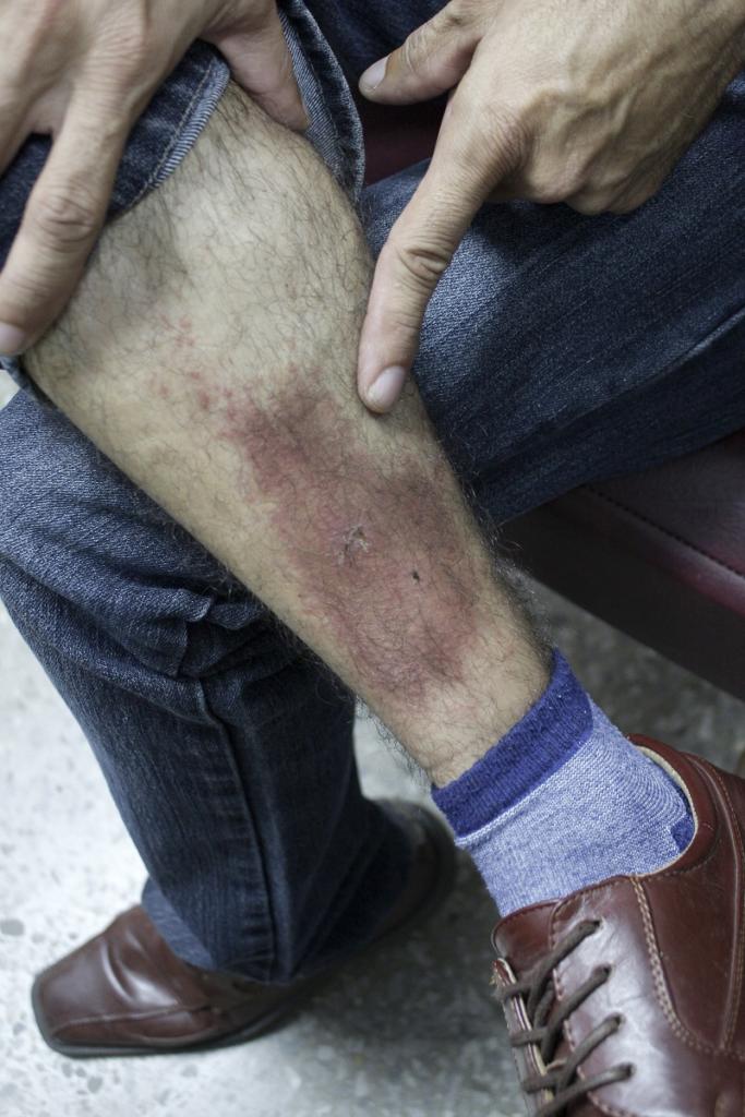 Las erupciones en la piel deben secarse con cuidado, empleando toallas suaves y sin frotar la piel, pero comprobando que no queden zonas húmedas. | foto: René Pérez Massola