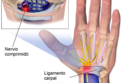 Síndrome del túnel carpiano: Un pasadizo con dolor