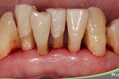 Estatinas disminuyen la periodontitis
