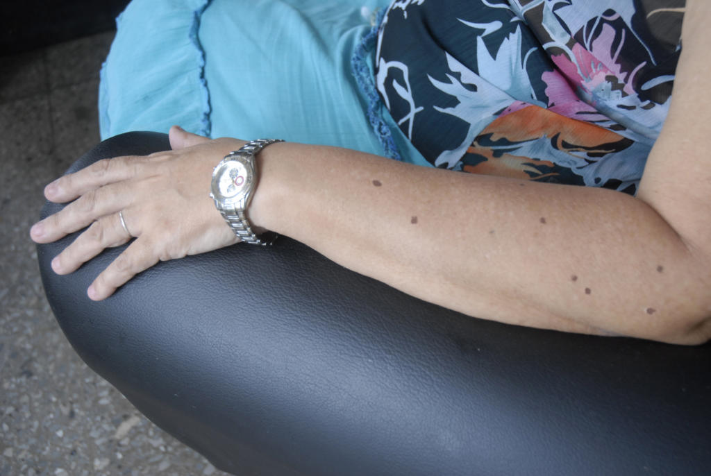 La cantidad de lunares en un brazo: nueva pista para descartar pacientes de riesgo de padecer cáncer de piel. Foto: Agustín Borrego