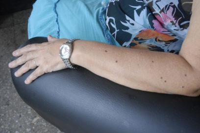 ¿Cáncer de piel según cantidad de lunares?