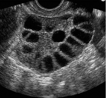 En ocasiones la forma de alojamiento de los quistes es comparada con la de las semillas de los melones. | foto: Ultrasonido cortesía del doctor Alfredo Brito