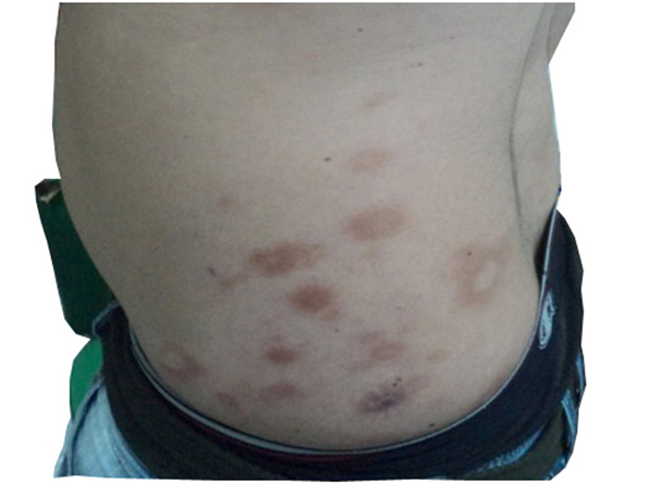 Cartas de presentación de la lepra