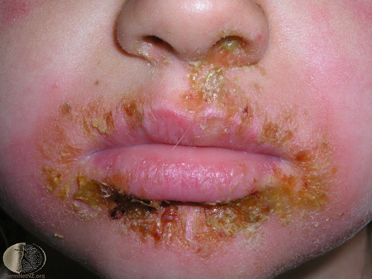 El impétigo es una enfermedad contagiosa, puede comenzar alrededor de la nariz y la boca y extenderse a otras zonas del cuerpo. Tiene más incidencia en los niños. Foto: Tomada de Epidemiologia Escobar