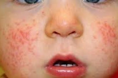 Enfermedades detrás de erupciones en la piel