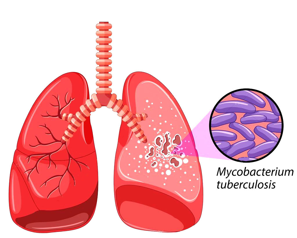 pulmón TB
