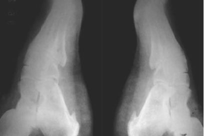 ¿Por qué duelen los pies?