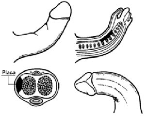 Diversas incurvaciones del pene ocasionadas por la enfermedad.