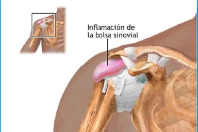 ¿Quién no ha sufrido de bursitis?