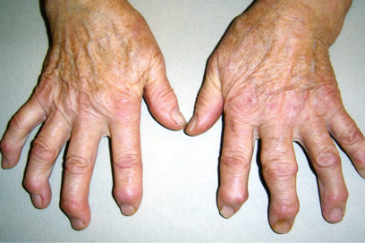 ¿Mano enferma? Pérdida o disminución del trabajo