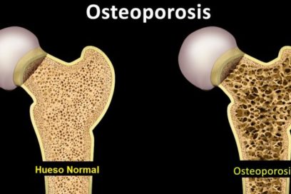 Osteoporosis: una enfermedad silenciosa