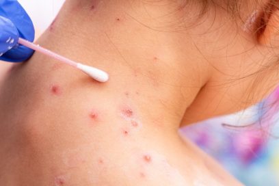Declara OMS a virus de viruela símica como emergencia sanitaria