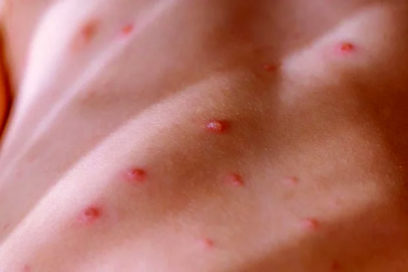 Redobla Cuba vigilancia epidemiológica