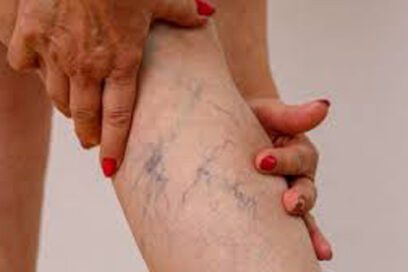 Várices: ¿más propensos hombres o mujeres?