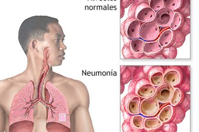 Alertas ante la neumonía