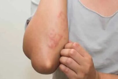 Alergia a medicamentos